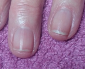 Eileen IBX 2nd treatment